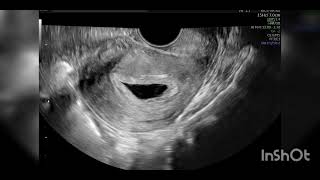 Heterotopic pregnancy on fetal ultrasound USG [upl. by Britt]