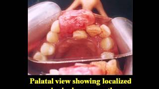 Surgical Excision of Localized Gingival Overgrowthavi [upl. by Alliuqaj827]