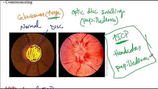 USMLE ACE Video 199 Overview of Hydrocephalus Types and Associated Conditions [upl. by Yhtomit]