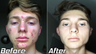 How I Cleared My Acne  Acne Transformation Story 2020 [upl. by Neltiac337]