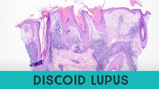 Discoid Lupus Erythematosus under the microscope pathology dermatology dermpath [upl. by Enelyak750]