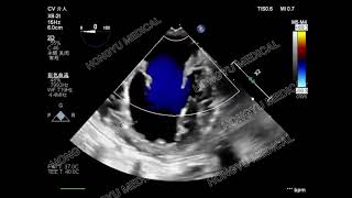 Ultrasound image of dog mitral valve regurgitation [upl. by Pelagia]