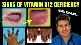 Doctor explains clinical signs of Vitamin B12 cobalamin deficiency  Glossitis mouth ulcers etc [upl. by Kayley780]