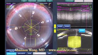 Lensx laser cataract surgery  brunescent cataract 101512 [upl. by Michigan]