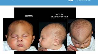 Neurosurgery Medical Student Primer  Craniosynostosis [upl. by Josler]