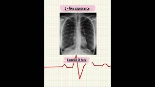 RADIOLOGICAL SIGNS IN CARDIOLOGY 🫀 CARDIOLOGY  CXR radiology viral shorts [upl. by Halet]