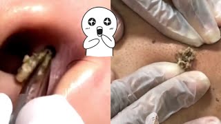 Ultimate Compilation Satisfying Blackhead Removal and Acne Treatment Highlights [upl. by Lunn]