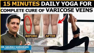 EXERCISE FOR VARICOSE VEINS  YOGA FOR VARICOSE VEINS  Dr Gaurav Gangwani [upl. by Edi]