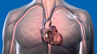 What Is a Pacemaker and How Does It Work [upl. by Natividad]