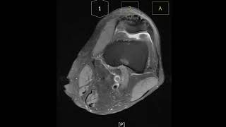 Prepatella bursitis with bursal wall thickening [upl. by Persas]