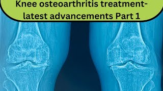 Part 1 Latest advancements in knee arthritis treatment Live with Dr Pankaj Walecha youtubelive [upl. by Yatnahc136]