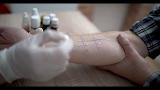 What is Skin Prick Testing [upl. by Thacker130]