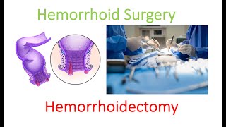 What is hemorrhoidectomy surgery Get the REAL details here  Dr Chung explains [upl. by Nonnahsal557]