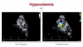 What does abnormal collapsibility of the IVC look like [upl. by Charles298]