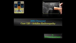 Ultrasound Case 125  Achilles Enthesopathy [upl. by Atirak]