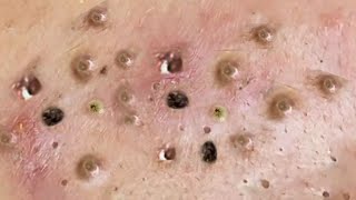 Satisfying big blackhead removal  Pimple popping 120 [upl. by Ecnal]