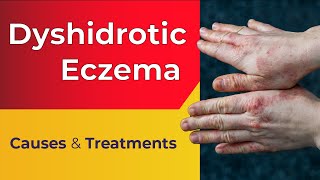 What is Dyshidrotic Eczema  Overview Causes Treatments [upl. by Anital]