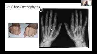 Genetic Haemochromatosis  Joint pain and arthropathy with Professor Patrick Kiely [upl. by Anaitat]