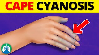 Cape Cyanosis Medical Definition  Quick Explainer Video [upl. by Shifrah225]