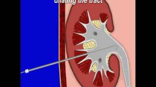 Percuteous Nephrostomy [upl. by Nauqed]