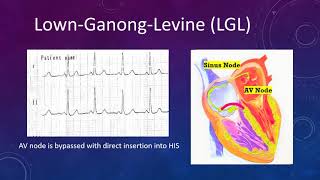 ECG I ACCESSORY PATHWAY I LGL [upl. by Atik603]