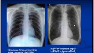 Chest xray interpretation COPD and Emphysema [upl. by Eelarol317]