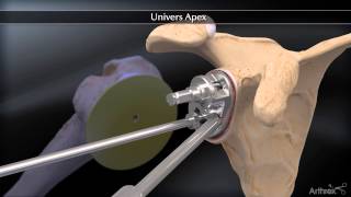 Apex Total Shoulder Arthroplasty Systems [upl. by Roque707]