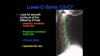 Radiology of Spine Trauma [upl. by Gregor627]