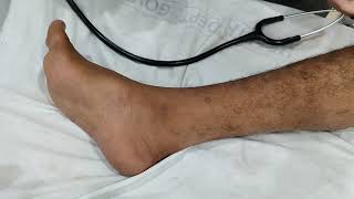 Bilateral Hyperreflexia and Ankle Clonus [upl. by Mailliwnhoj672]