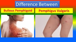 Difference Between Bullous Pemphigoid and Pemphigus Vulgaris [upl. by Lavro]