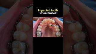 Pull impacted tooth with braces orthodontist bracesoff dentist braces [upl. by Babette]