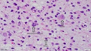 Diffuse Astrocytoma IDH mutant  Adventures in Neuropathology [upl. by Aiyram]