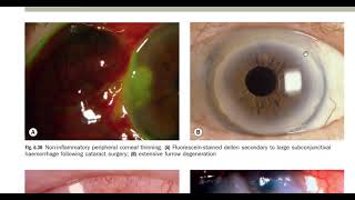 Kanski made easy  Cornea 4 [upl. by Hickey]