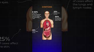 Know About Sarcoidosis I Akshar Pulmo Care sarcoidosis lungshealth science education [upl. by Frasco713]