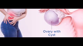 Ovarian Cyst Pain Treatment [upl. by Adnorahs]