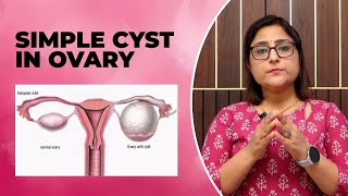 simple ovarian cyst ओवरी में सिस्ट  क्या करें [upl. by Ynagoham728]