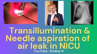 Transillumination and needle aspiration in treatment of air leaks in neonates pneumothorax [upl. by Benoit]