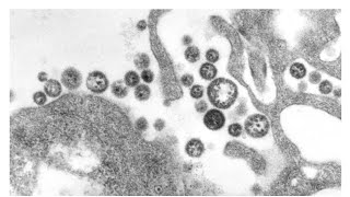 Lassa fever reported in US Plagues increasing [upl. by Onofredo41]