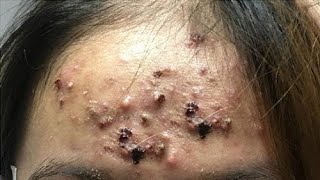 Big Cystic Acne Blackheads Extraction Blackheads amp Milia Whiteheads Removal Pimple Popping [upl. by Soisanahta]