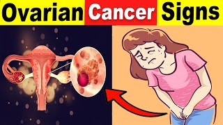 9 Common Ovarian Cancer Signs That You Should Never Ignore [upl. by Brittani122]