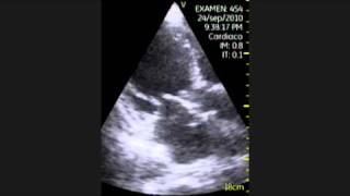 VSCAN Aortic endocarditis Endocarditis aórtica y port a cath Pocket Ultrasound [upl. by Magel]