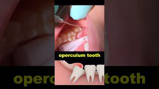 Operculum tooth treatment dentist dentistry wisdomtooth [upl. by Sirraj520]