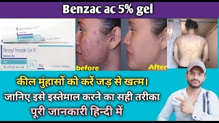 Benzac ac 5gel use benefits and Side effects full review in hindi [upl. by Norvell]