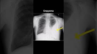 Empyema xray radiology röntgen thorax empyema [upl. by Jennie]