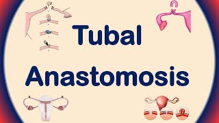 Tubal Anastomosis  Tubal Ligation Reversal  Tubal Reversal Procedure [upl. by Maurice223]