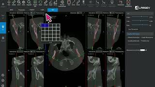 AITMJ Analysis Software  How LargeV AI assesses TMJ condition professionally and comprehensively [upl. by Rosemarie]