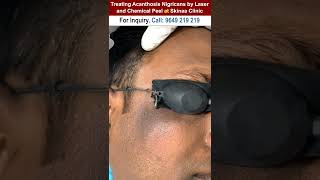 Treating Acanthosis Nigricans by Laserand Chemical Peel at Skinaa Clinic treatingacanthosisshorts [upl. by Odracir]