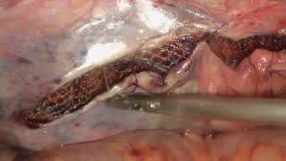 Laparoscopic Inguinal Hernia Repair TAPP 9  TAPP Plus [upl. by Lissi897]