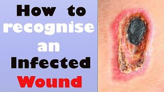 How to recognize an Infected Wound [upl. by Kaczer309]