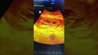 Hydatidiform mole HM ultrasound shorts shortvideo [upl. by Suoilenroc765]